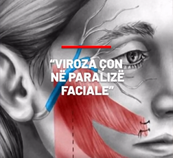 Viroza con ne paralize faciale