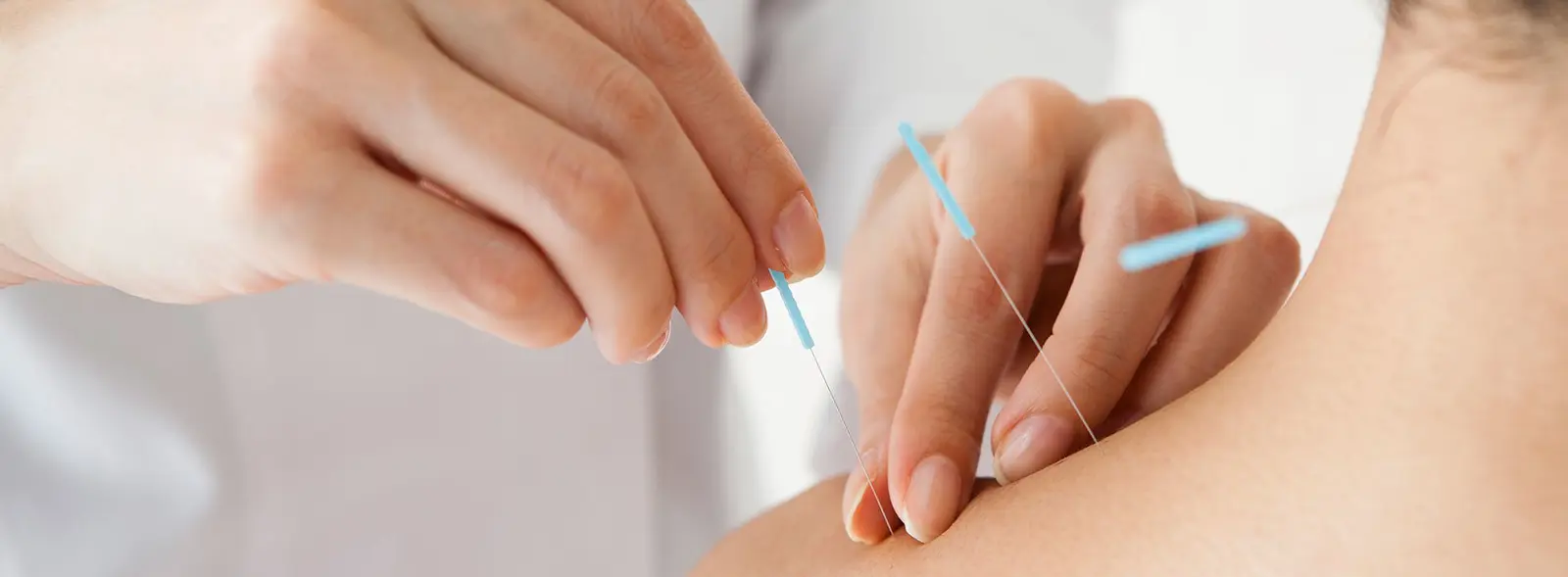 Dry Needling